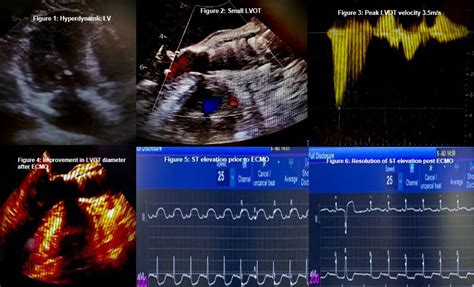 suicide lv|Unexpected suicide left ventricle post.